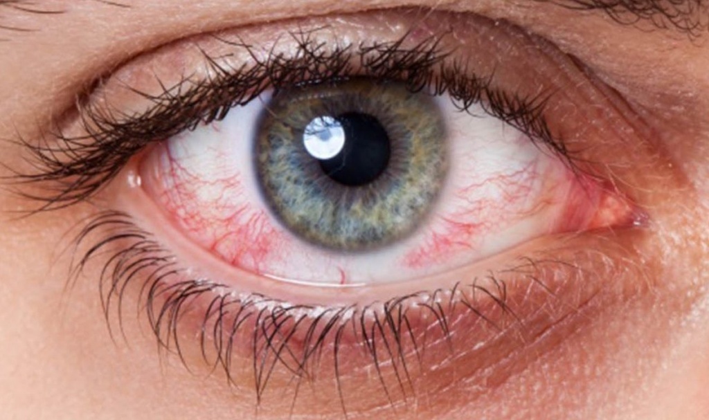 Синдром «сухого глаза»