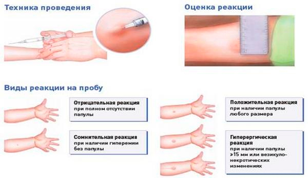 Результат диаскинтеста