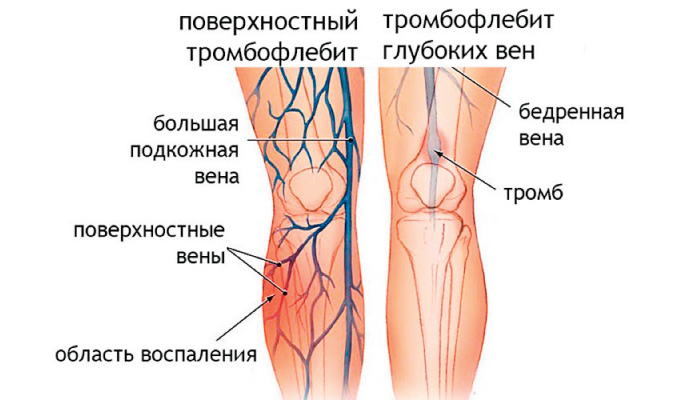 Лечение тромбофлебита