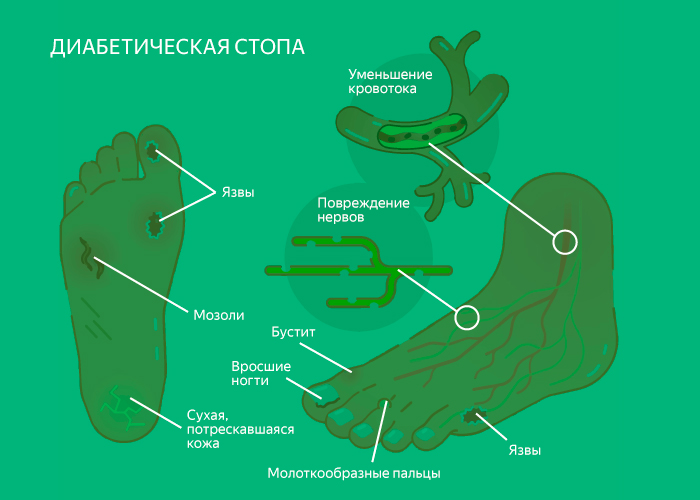 Симптомы диабетической стопы