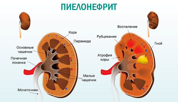 Лечение пиелонефрита